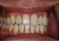 After - London Bridge Dental Practice