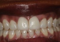 After - London Bridge Dental Practice