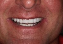 After - London Bridge Dental Practice