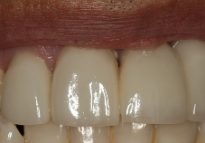 After - London Bridge Dental Practice