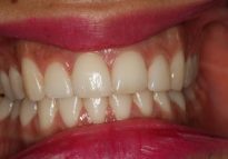 After - London Bridge Dental Practice
