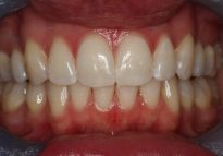 After - London Bridge Dental Practice