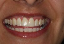 After - London Bridge Dental Practice