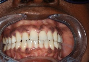 After - London Bridge Dental Practic