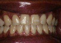 After - London Bridge Dental Practice