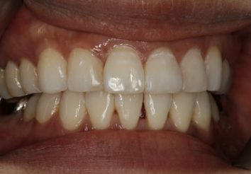 After - London Bridge Dental Practic