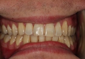After - London Bridge Dental Practic