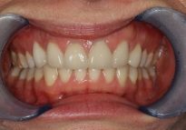 After - London Bridge Dental Practice