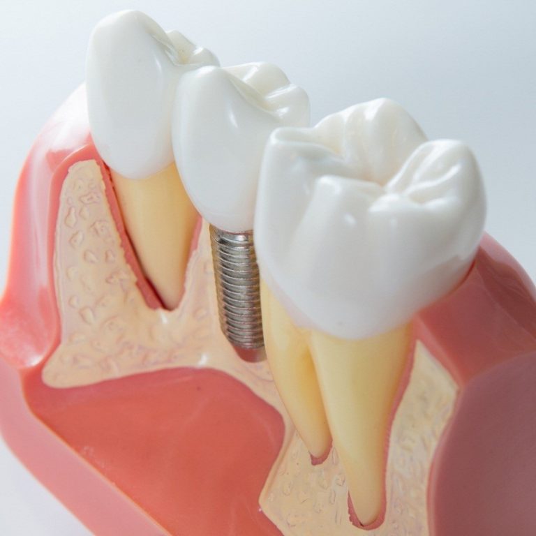 Benefits Associated With Dental Implants London London Bridge Dental